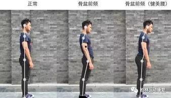 成人严重驼背视频讲解图,成人严重驼背成因及矫正方法解析